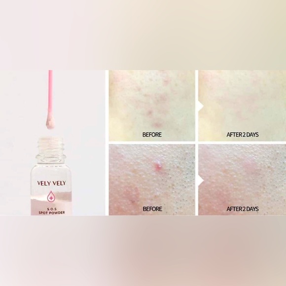 VELY VELY S.O.S Spot Powder - Acne , Blemish Rescue Treatment ( Pack of 2 ) - Picture 5 of 6